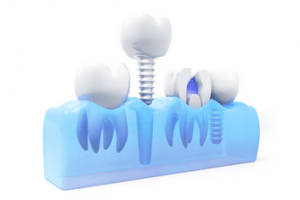 Högkostnadsskydd tandvård implantat